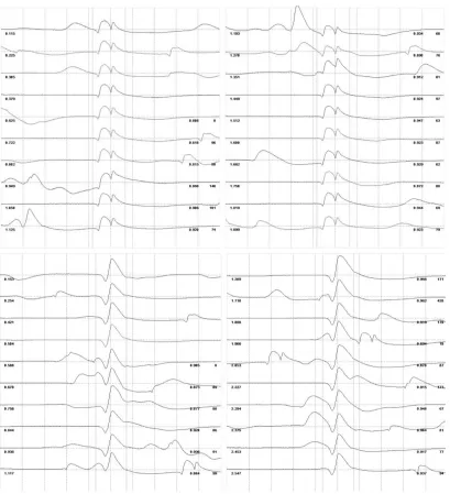 Figure 4: Raster plots for two MUP trains algorithmically classified as 