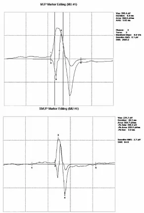 Figure 5: Motor unit potential (MUP) template and corresponding spike-