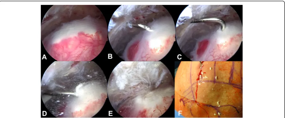 Fig. 1 Surgical steps for minimally invasive arthroscopic removal of rotator cuff calcifications