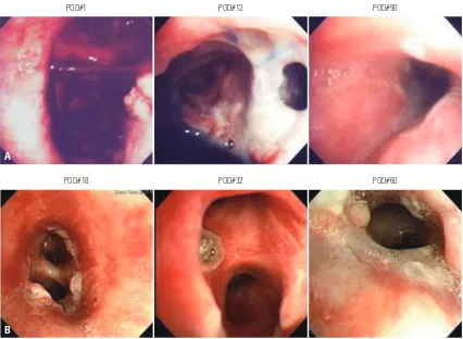 Fig. 2. Representative photographs of early anastomotic airway complications. (A) A case of early airway complication presenting fistula at anasto-mosis site