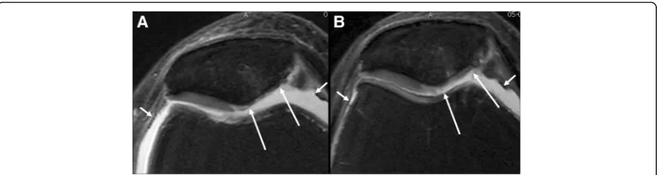 Fig. 2 Axial intermediate-weighted fat-suppressed MRI in treated patient at baseline (a) and 12 months (b) follow up show improvement of cartilagefocal defect and thickness of the medial patella (long arrows)