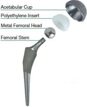 Figure 1-4 - The components of a common THA design, in this case a metal femoral head articulating on a modular polyethylene acetabular liner (Permissions from Total Hip Arthroplasty (THA)