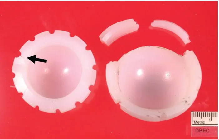 Figure 1-8 - Example of a failed HXLPE acetabular liner at the rim of the implant (permissions from Tower SS