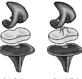 Figure 2: Cruciate retaining and posterior stabilized knee implants. 