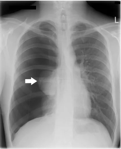 Figure 1. Postero-anterior chest radiograph documenting a complete right-sided 