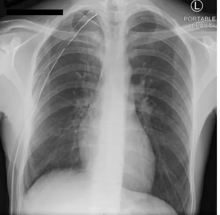 Figure 3. Following surgery for primary spontaneous pneumothorax with persistent 