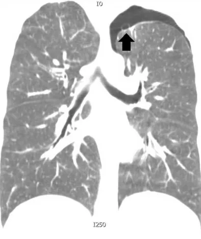 Figure 4. Coronal view of the chest computed tomodensitometry performed in a 