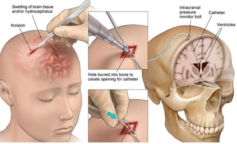 Fig. 2.6: Ventriculostomy procedure workﬂow (source: https://goo.gl/yB6cCn).