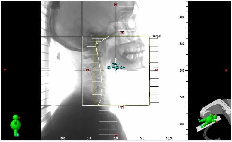 Figure shows 2D planning with MLC shielding of anterior field 