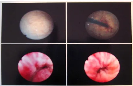 Figure 6: Images from a cystoscopy. The top two images show the interior of a bladder