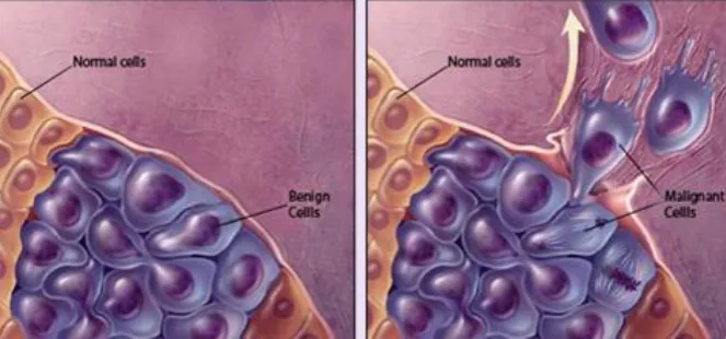 Fig. 1 Example of the benign tumor cells and malignant tumor cells 