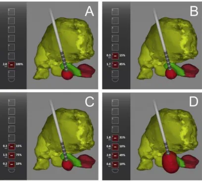 Figure 3: Altered electrical field shape using current steering Electrode location shown in anatomical relation to the thalamus (yellow), STN (green), and red nucleus (maroon)