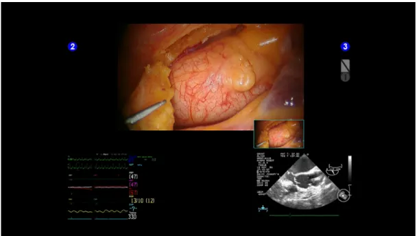 Figure 1.6: The TilePro TM display (bottom) in daVinci surgeon’s console, with the primary dis-