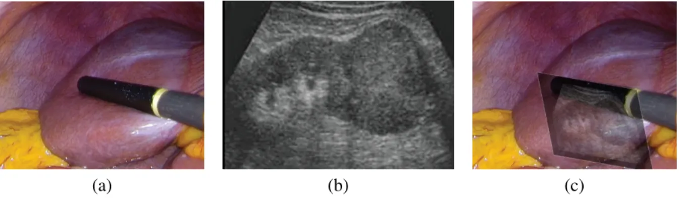 Figure 1.9: (a) laparoscopic camera image (monocular) showing the imaging tip of a LUS