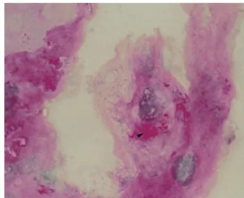 FIG. 2. PAS staining showing the bacterium in infected HEL cells (arrowhead). Magniﬁcation, �1000.