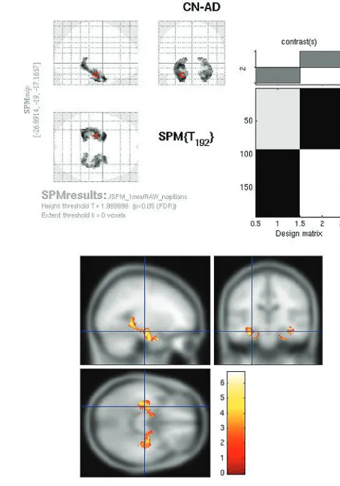 Fig 2. Raw FDG SPMt for CN-AD thresholded at P � .05 with FWE correction. Strongposterior cingulate gyrus and bilateral parietal metabolic activity differences are present.There is no activity difference that survives correction in the hippocampal regions.