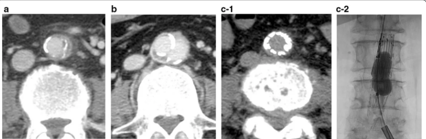 Fig. 3  Lumbar images obtained 40 days after prostate biopsy. 
