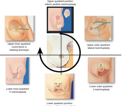 Figure 1.3 Overview of level 2 oncoplastic surgical reconstruction 