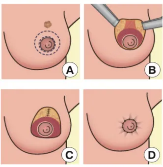 Figure 1.4 Round block mastopexy technique in level 2 oncoplastic 