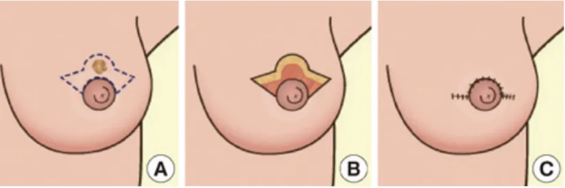 Figure 1.6 Batwing mastopexy in level 2 oncoplastic surgery. Batwing 
