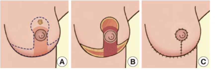 Figure 1.10 Wise pattern reduction in level 3 oncoplastic surgery. Wise 