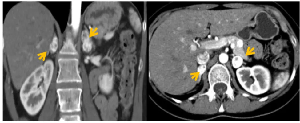 Figure 3: Abdominal CT scan – bilateral pheochromocytoma– A. arterial phase – coronal; B