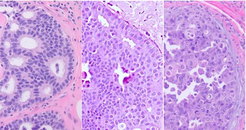 Figure 1.1.5 – Ductal carcinoma in situ (DCIS) of the breast. 