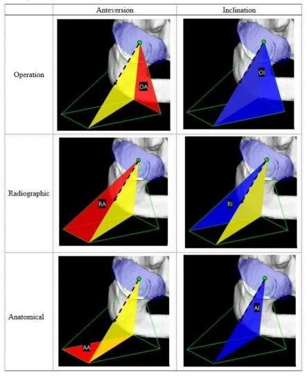 Fig. 6. Definition of the acetabular version 