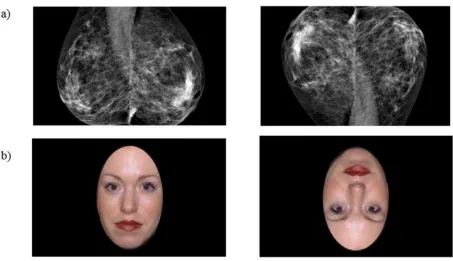 Figure 1. Examples of mammogram and face stimuli in the upright and inverted orientations (a) upright and inverted abnormal mammogram (b) upright and inverted smiling face