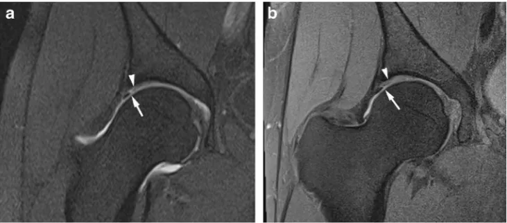 Fig. 2 Acetabular labrumT1 FS 1.5T MRA shows no tear(arrowhead) and (MR images shows complete basalcomplete tear in a 29-year-oldconfirmed at surgery