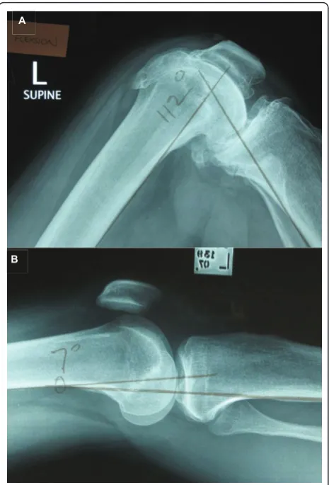 Figure 3 Patient x-rays demonstrating measurement of anglesin flexion and extension.