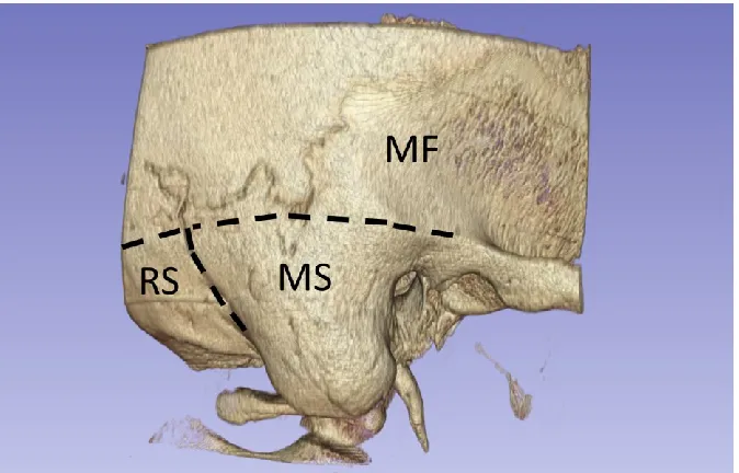 Figure 1-6: Locations for BONEBRIDGE implant.  Mastoid (MS), retrosigmoid 
