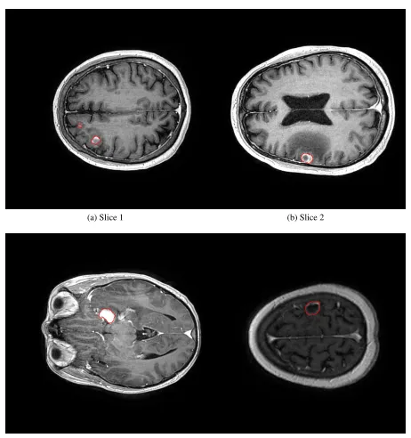 Figure 1.5: Examples of brain tumor diversity in size, location and shape. The red contours arethe boundaries of the ground truth