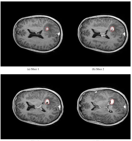 Figure 1.6: Examples of inconsistent appearance of tumor. The red contours are the boundariesof the ground truth
