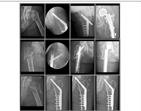 Fig. 3 From left to right preoperative, intra/postoperative, post technical complication and final radiographs of the typical and most frequenttype of technical complication that occurred with dynamic hip screw (medialisation and nonunion followed by hip joint replacement, upperpanels), intramedullary nail (nonunion followed by hip joint replacement, middle panels) and uniaxial Medoff sliding plate (Twin hook penetrationfollowed by Twin hook replacement and fracture healing, lower panels)