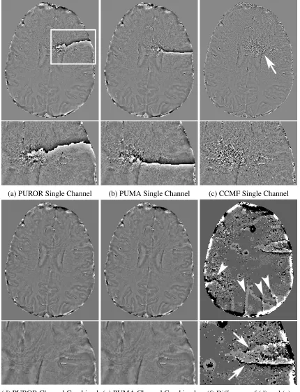 Figure 2.14: Residual phase wrapping artifacts present in channel combined images created using phaseunwrapping paradigm.