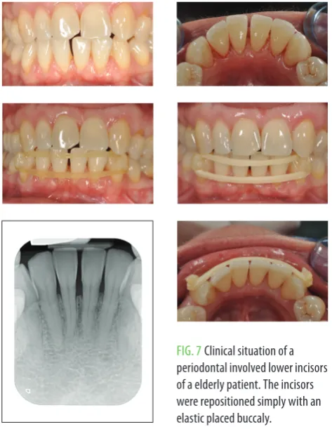FIg. 4 The field was isolated by rubber dam, interproximal spaces protected by microbrushes, and the 3D printed retainer, after being sandblasted, was luted with dual-cure resin composite cement (LinkForce, gC).