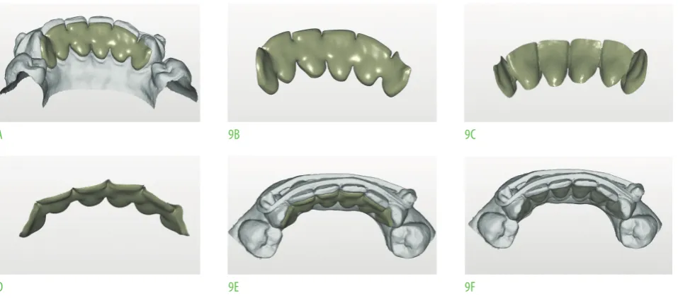 FIg. 8 Different views of the screen of the ioS (a, B, C, D) (aadva, gC) and two views of the generated .stl file (e, F).
