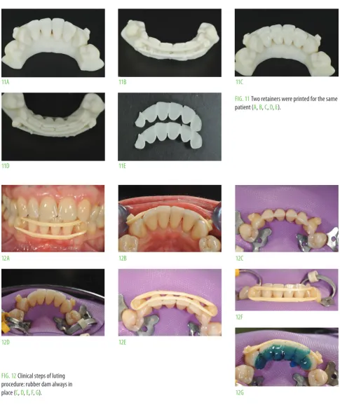 FIg. 11 patient (Two retainers were printed for the same a, B, C, D, e).