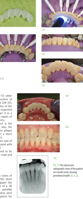 FIg. 13 and the incisors after the retainer has beinf luted (protection with microbrushes of the interproximal spaces (...the sandblasted internal surface of the retainer (B), C, D, e) F, g, h).