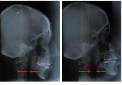 Figure 
  1. 
   
  Lateral 
  cephalometric 
  radiographs 
  taken 
  before 
  (Figure 
  1a) 
  and 
  after 
  (Figure 
  1b) 
  maxillomandibular 
  advancement 
  surgery