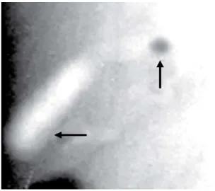 Fig 9: Oral cholecystogram with smooth filling defect (Cystic duct stone). 
