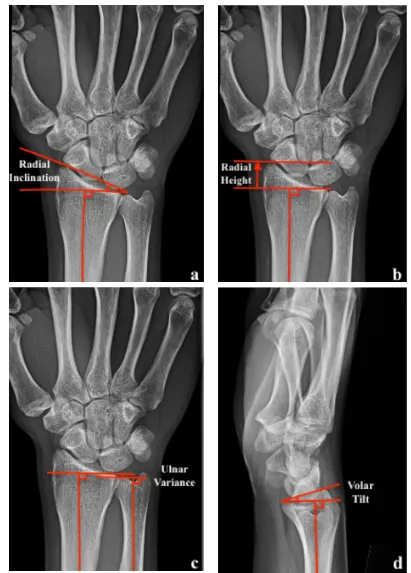 Figure 1. 3 Anatomic radiographic parameters of the distal radius. PA radiographs showing radiographic measurements of (a) Radial inclination (b) Radial height and (c) Ulnar variance