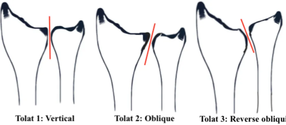 Figure 1. 10 Configurations of DRUJ in the coronal plane 