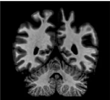 Fig. 1. Coronal slice of R.F.S. ’s brain. MRI scan, August 2011, presented in neurological convention (left side of image is right hemisphere)