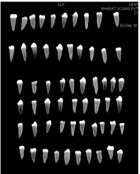 Fig No.2 Spiral Computed Tomography   Scan for tooth selection. 