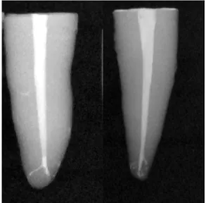 Fig No.8 Obturation with ProTaper  