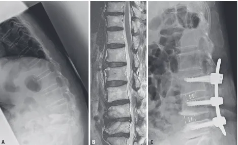 Fig. 3. A 68-year-old woman showing spondylolisthetic degeneration at L4. MRI (A and B) and myelography (C) showing spondylolisthetic degeneration at L4 and spinal stenosis at L4–5