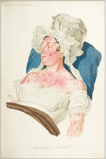 Figure 2: Baron Jean-Louis Alibert. “Scarlatine Normale (Woman with Scarlet Fever)” in Clinique de l’Hôpital Saint Louis