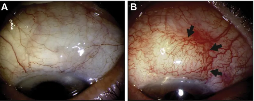 Figure 1.3.1 Clinical presentation of filtering blebs.  